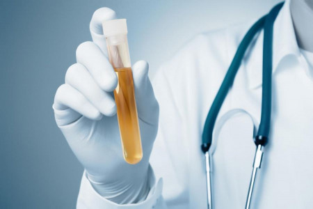 آزمایش وزن مخصوص ادرار | Specific gravity در آزمایش ادرار چیست ؟