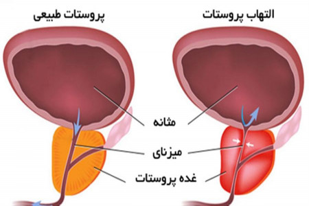التهاب پروستات چیست ؟ آیا التهاب پروستات درمان میشود ؟