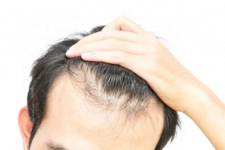ریزش مو پس از عمل چیست؟ چرا اتفاق میافتد؟