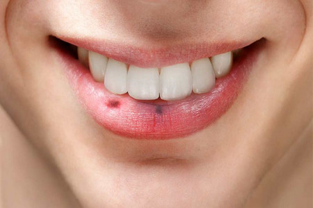 علت لکه و خال سیاه روی لب چیست؟
