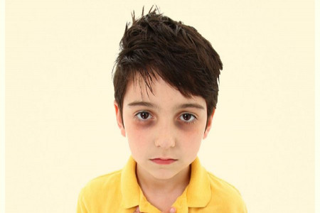 علت تیرگی دور چشم نوزادان چیست و چگونه درمان میشود ؟