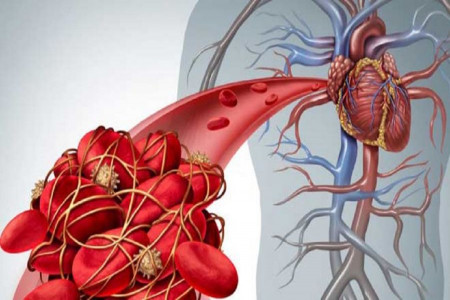 علائم و نشانه های هشدار دهنده آمبولی ریوی کدامند ؟