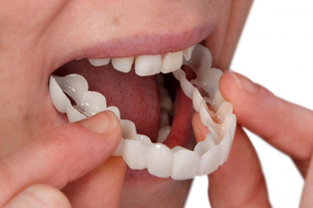کاور دندان (snap on smile) چیست و چه کاربردی دارد ؟