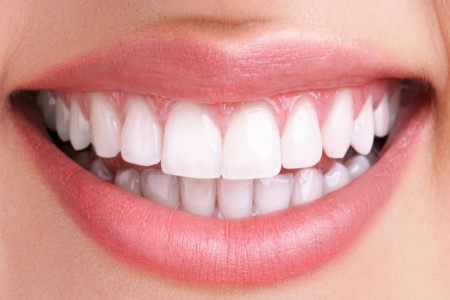 مینی ایمپلنت (mini implant) چیست و چگونه کاشته میشود ؟