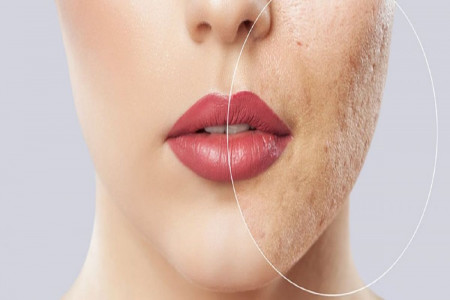 مراقبت های بعد از سابسیژن