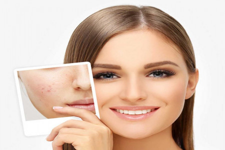 راهکارهای طلایی برای رفع آکنه در منزل
