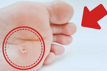 زگیل کف پا چیست و چه علائمی دارد ؟