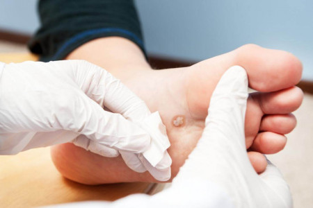 بررسی تشخیص و علل ایجاد زگیل کف پا