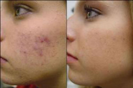 آیا حجامت تاثیری بر جوش های صورت دارد؟
