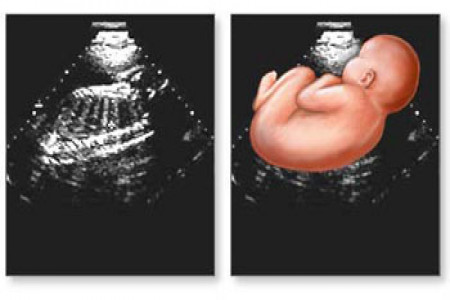 پاسخ به 13 سوال رایج درباره سونوگرافی