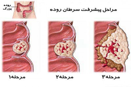 قاتل خاموش و مرگباری بنام سرطان روده!