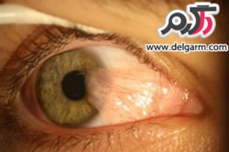ناخنک چشم (تریژیوم) چیست و راه درمان آن چگونه است؟