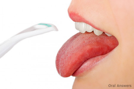 برای رفع سفیدی روی زبان چه کنیم؟