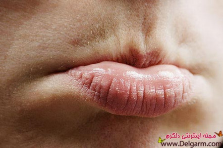 خشکی و ترک لب + درمان فوری