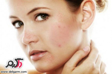 محصولات مناسب برای جوشهای زیرپوستی