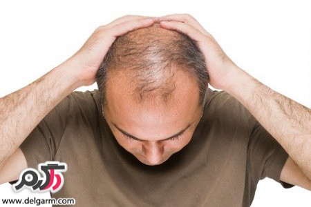 این نوع ریزش مو برگشت پذیر است