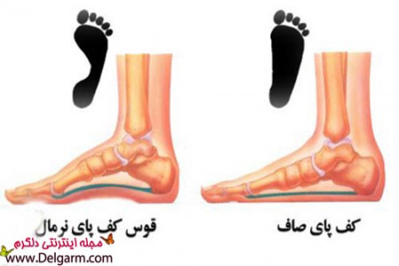 علت های صافی کف پا + عکس