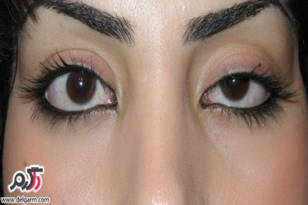 چرا دچار افتادگی پلک میشویم؟به همراه راهکارهای درمان افتادگی چشم+تصاویر و فیلم