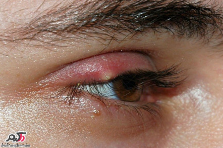 گل مژه(Hordeolum) چیست؟ راه های درمان گل مژه روی پلک چیست؟