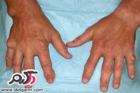 روماتیسم مفصلی(Rheumatoid arthritis) چیست؟ و درمان روماتیسم آن به چه روشی انجام میشود؟
