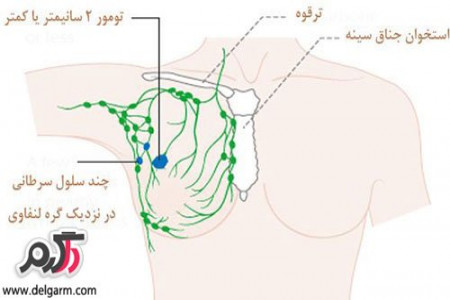 علت زدن توده ی زیر بغل چیست؟