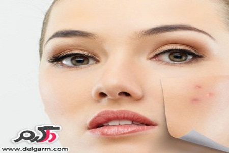 بهترین راه های برای درمان جای جوش صورت
