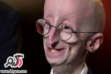 علت سندرم موبیس ( mobius syndrome )