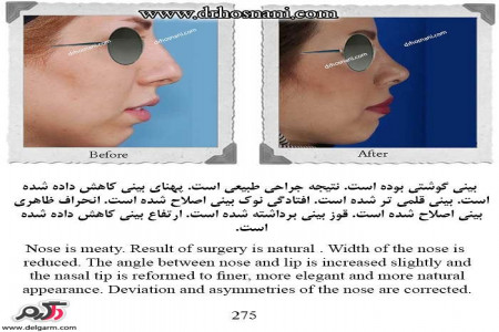 گالری از (رینوپلاستی) جراحی زیبایی بینی دکتر حمیدرضا حسنانی