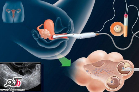 علت ناموفق بودن آی وی اف ( ivf )چیست؟