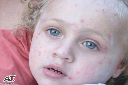 آنتی هیستامین،داروی ضدخارش آبله مرغان(chickenpox)