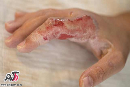 راه های مناسب برای کاهش درد سوختگی
