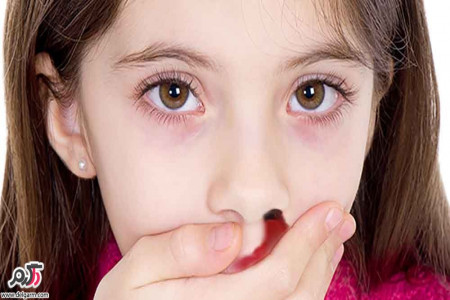 علت اصلی خون دماغ شدن چیست؟