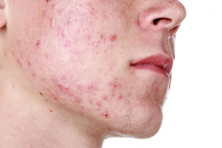 فواید باورنکردنی ژل آکدین دینه برای درمان آکنه