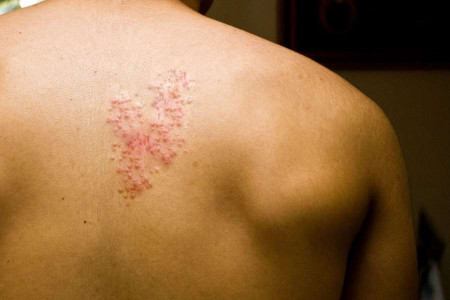 زونا چیست ؟ ۱۳ درمان خانگی زونا