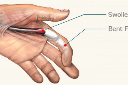 انگشت ماشه ای (trigger finger) چیست و چگونه درمان میشود ؟