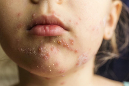 حساسیت به تخم مرغ چه علائمی دارد؟