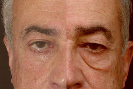 بلفاروپلاستی (جراحی پلک) چیست؟ چه عوارضی دارد؟