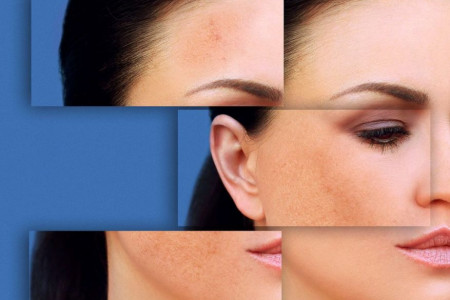 چگونه لک های صورت را از بین ببریم؟