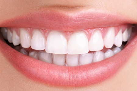مینی ایمپلنت (mini implant) چیست و چگونه کاشته میشود ؟