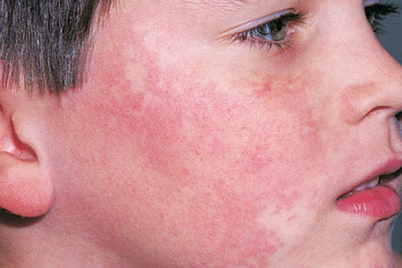 پوست سرخی عفونی در کودکان چگونه ایجاد میشود ؟