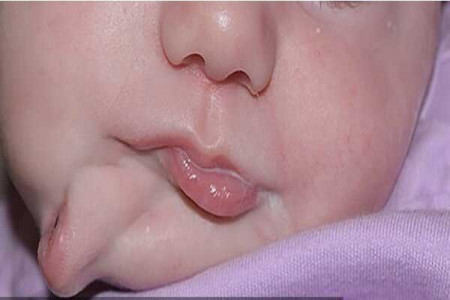 تولد نوزدای با دو دهان و زبان مجزا
