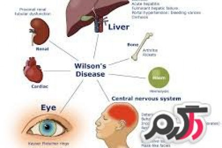درباره بیماری ویلسون چه میدانید؟