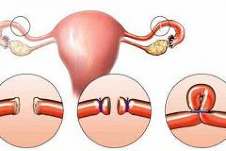 همه چیز درباره بستن لوله رحم در زنان