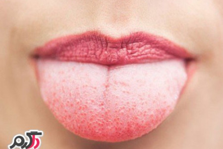 بهترین راه کارهای درمان سوختگی دهان و تاثیر باور نکردنی تخم مرغ برای سوختگی