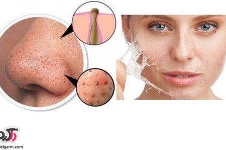 چگونه جوش های سر سیاه (کومودون ) را از بین ببریم؟