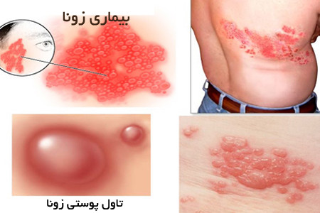 بیماری زونا