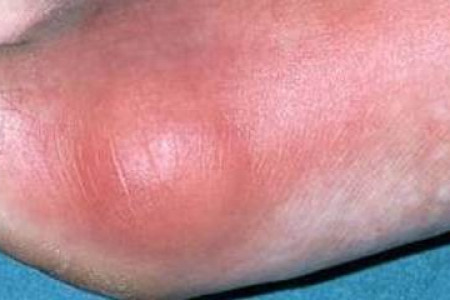 عوارض خطرناک بیماری نقرس