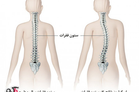 اسکولیوز (انحراف ستون فقرات)را چگونه درمان میشود؟