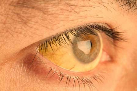 علت زردی اطراف مردمک و سفیده چشم