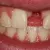 برای جای خالی دندان جلو بریج بهتر است یا ایمپلنت؟!